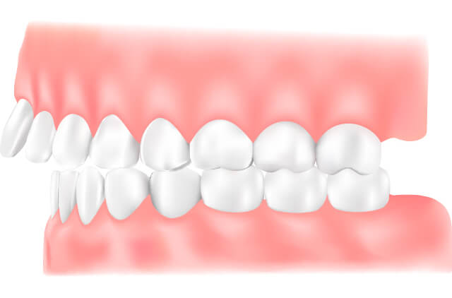 出っ歯(上顎前突:じょうがくぜんとつ)