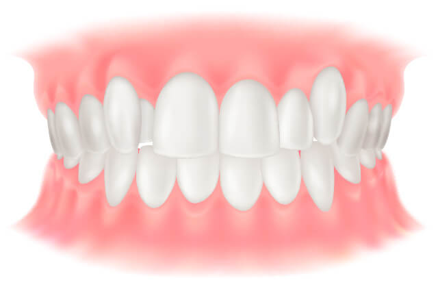 八重歯、乱ぐい歯(叢生:そうせい)